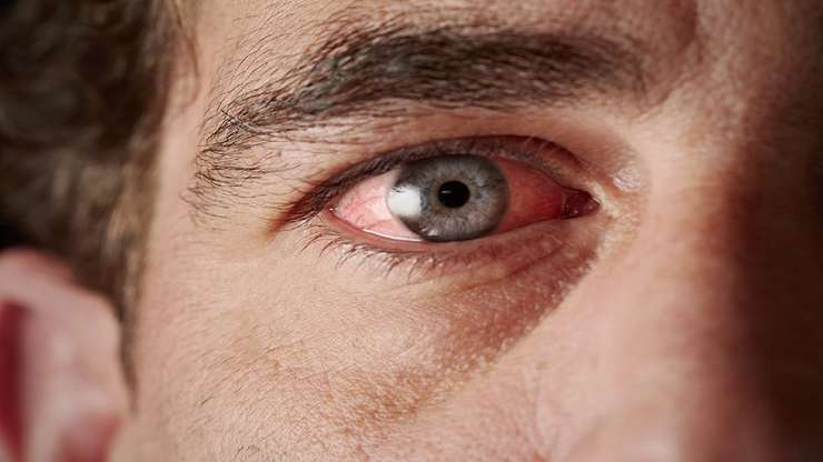 قوزقرنیه چیست؟ | بیماری‌های چشمی را جدی بگیرید