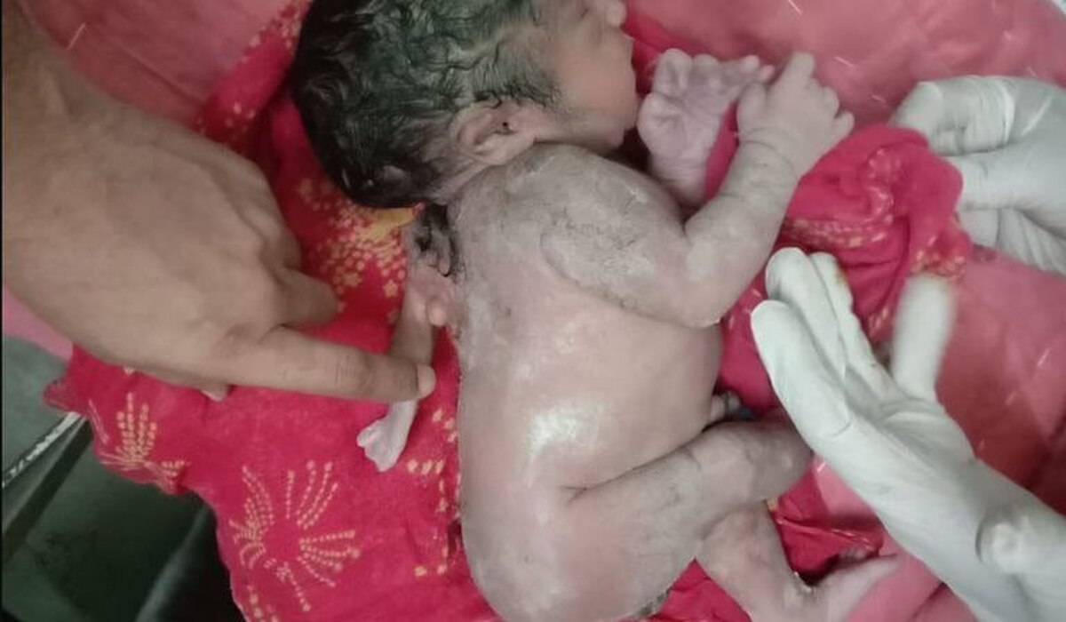 ویدئو| تولد نوزاد پسر با سه دست در هند