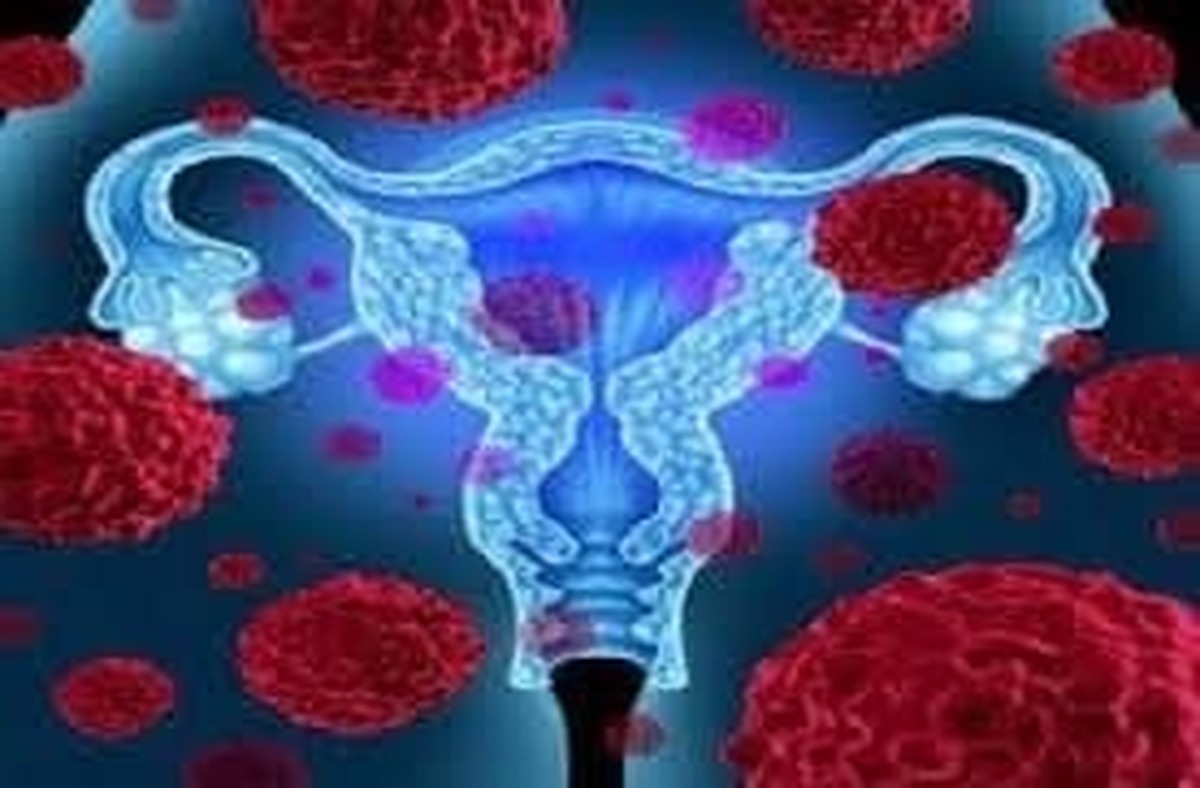 حدود ۴۲ درصد علل مرگ و میر ناشی از سرطان‌های سیستم زنانه، مربوط به سرطان تخمدان است