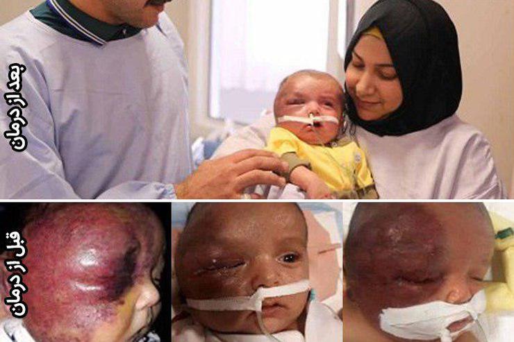 نجات کودک دوماهه عراقی مبتلا به یک سندروم نادر و کشنده به دست پزشکان ایرانی در مشهد