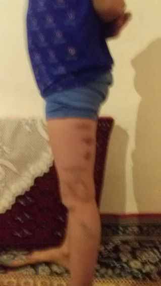 تنبیه بدنی دانش آموز قزوینی توسط معلم خشن + تصاویر دردناک