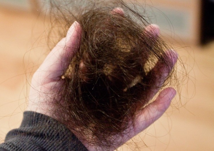 علائم جدید کرونا: ریزش مو و کچلی!