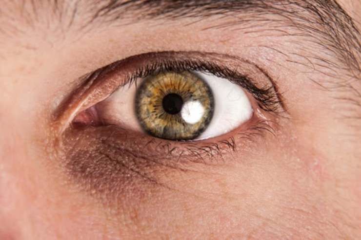 برای درمان حلقه های زیر چشم چه باید کرد؟