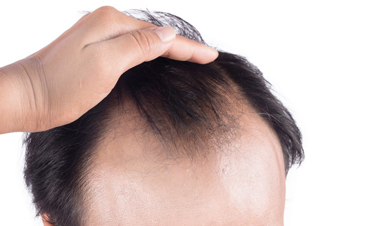 ریزش شدید مو جدیدترین پیامد ابتلا به کرونا در برخی بیماران