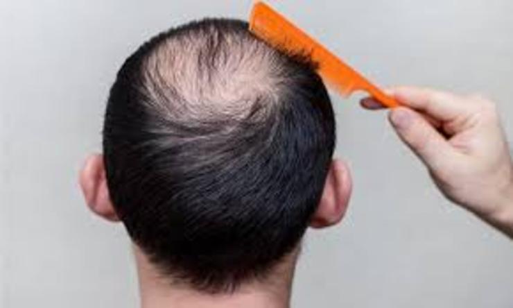 کشف شیوه ای علمی برای درمان۹۰ درصد طاسی  مو در دو هفته