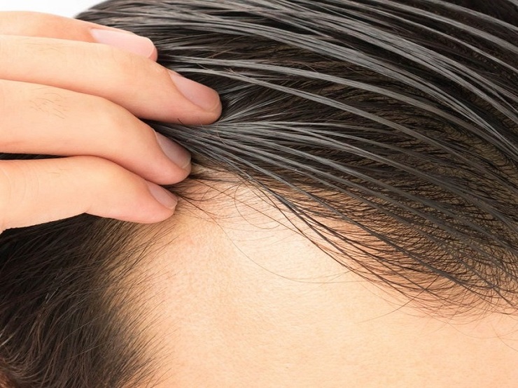 راهکار‌های از بین بردن چربی موی سر