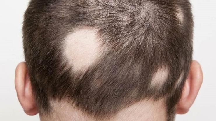 درمان ریزش موی سر با مصرف یک روغن گیاهی
