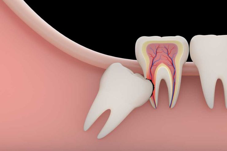 دلایل ایجاد دندان نهفته چیست؟ +راه‌های درمان آن