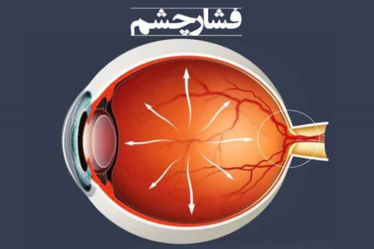اینفوگرافیک | با علائم افزایش فشار چشم آشنا شوید