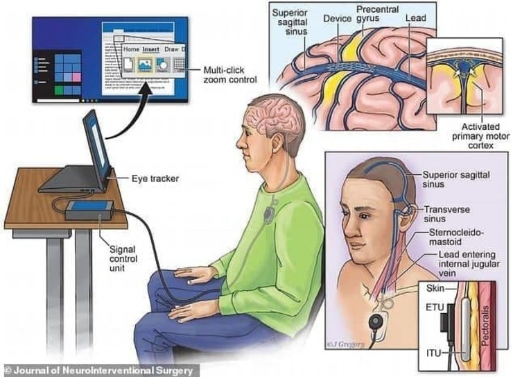 اولین توییت با مغز توسط یک بیمار فلج مغزی | رابط‌های مغز و رایانه امیدی تازه برای بیماران
