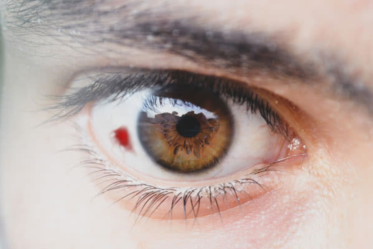 لکه‌ قرمز در چشم نشانه چیست؟