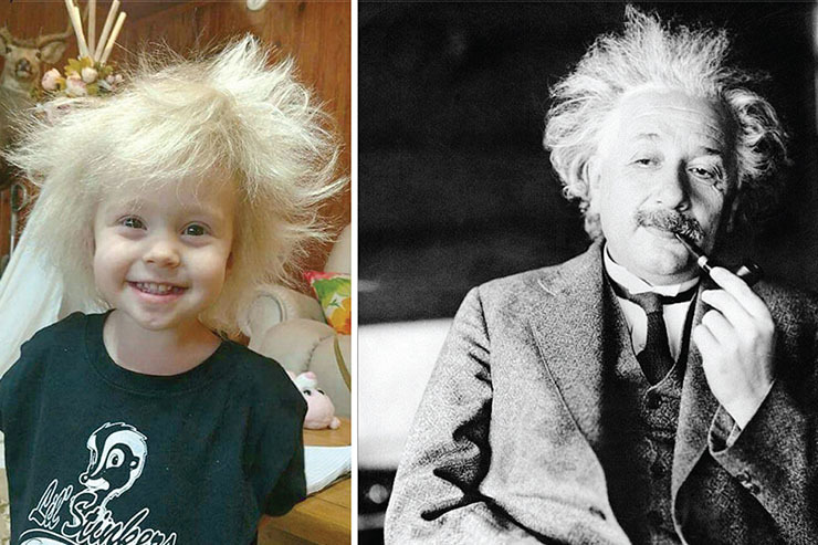سندرم موی آلبرت اینشتین!