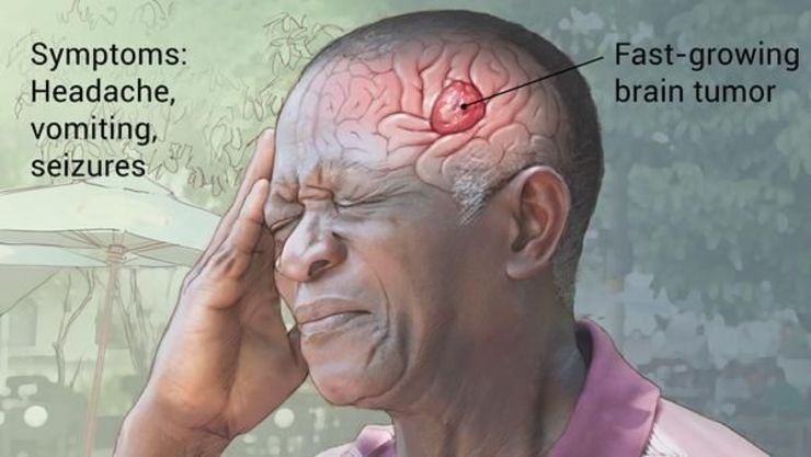 کدام نوع سردرد خبر از تومور مغزی می دهد؟