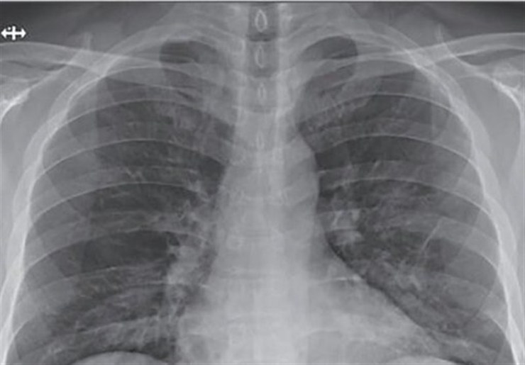 اینفوگرافی | علائم درگیر شدن ریه‌ها در بیماران کرونایی