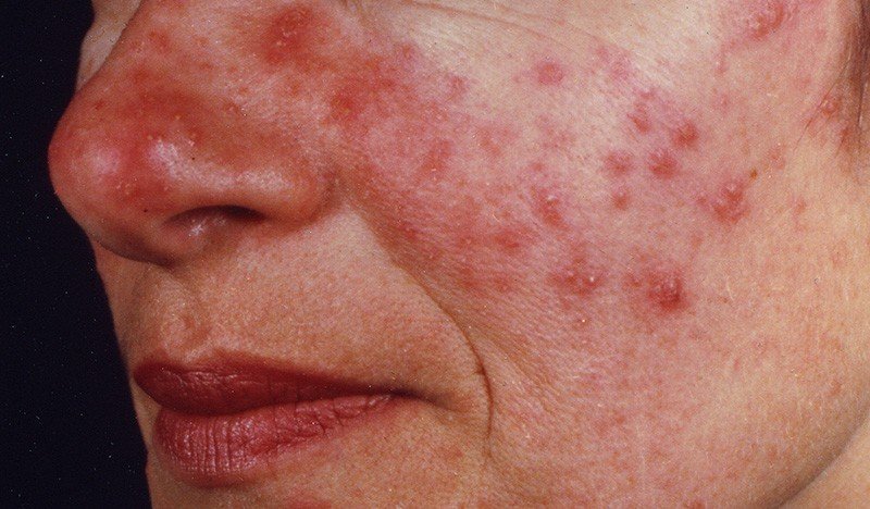 مشکلات پوستی در فصل پاییز + راه‌های درمان