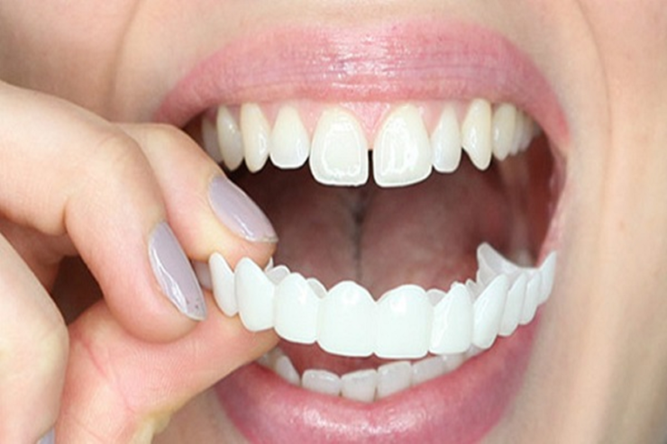 مزایا و معایب لمینت متحرک دندان + طرز استفاده و نگهداری آن