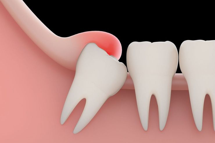 دلیل درد دندان عقل چیست؟ | چگونه از درد دندان عقل پیشگیری کنیم؟