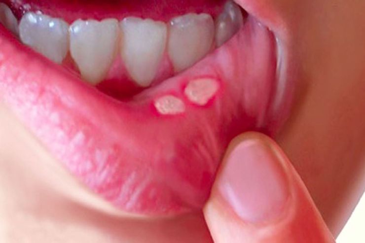چرا دهانمان دائما آفت می‌زند؟