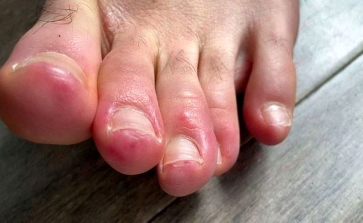 انگشت پای کوویدی، عجیب‌ترین علامت آلودگی به ویروس کرونا!