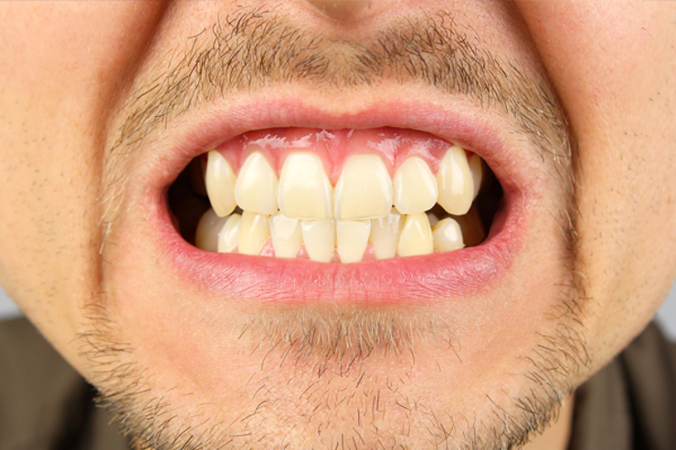 درباره عارضه‌ دندانی «دندان قروچه» بدانید