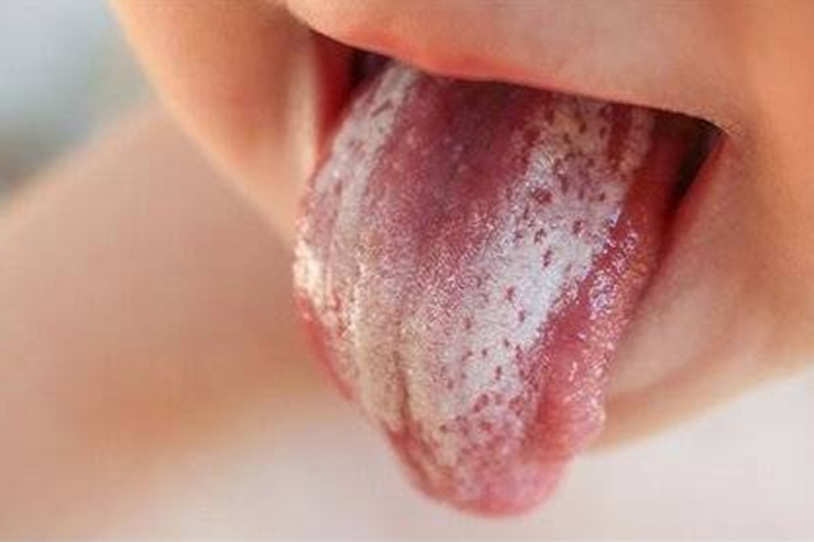 کدام میوه ها، باعث سندروم حساسیت دهان می شوند؟