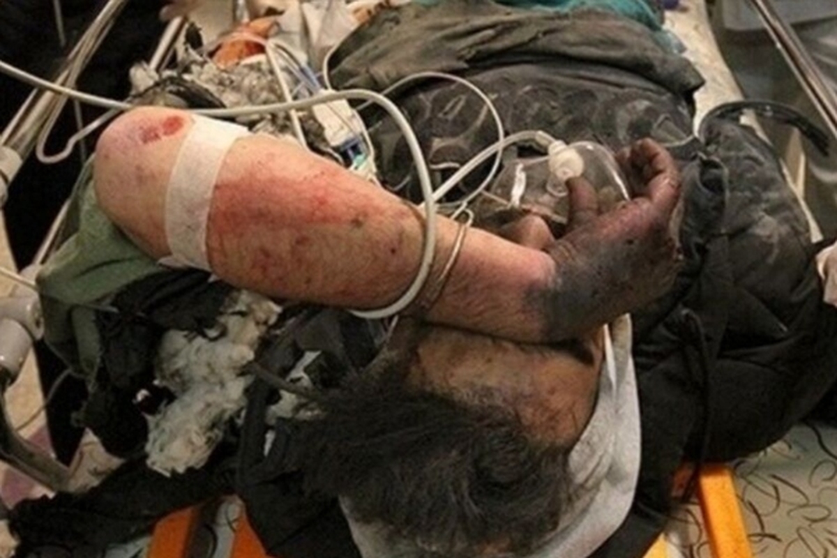 مصدومیت سه برادر پس از انفجار کیف حاوی مواد محترقه در قم