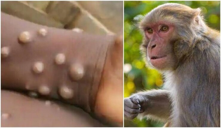 میزان اثرگذاری واکسن آبله بر «آبله میمونی» چقدر است؟