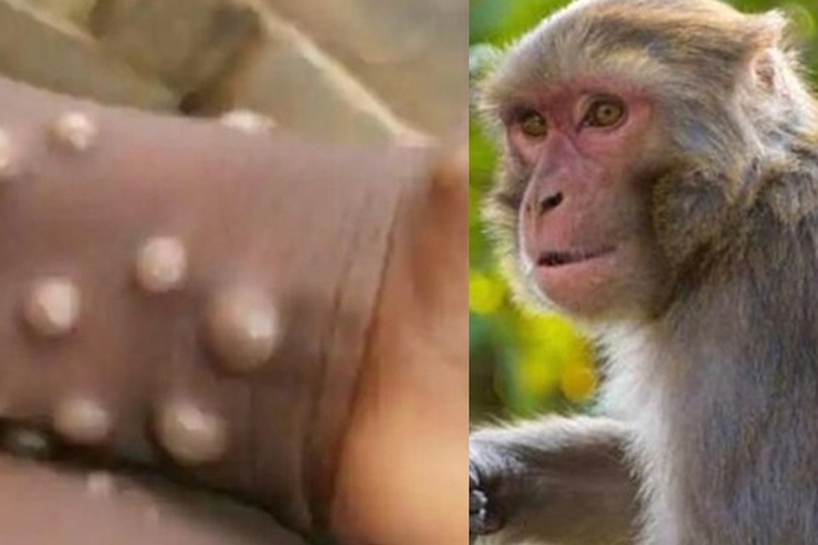 اولین مورد ابتلا به «آبله میمون» در همسایه جنوبی ایران شناسایی شد