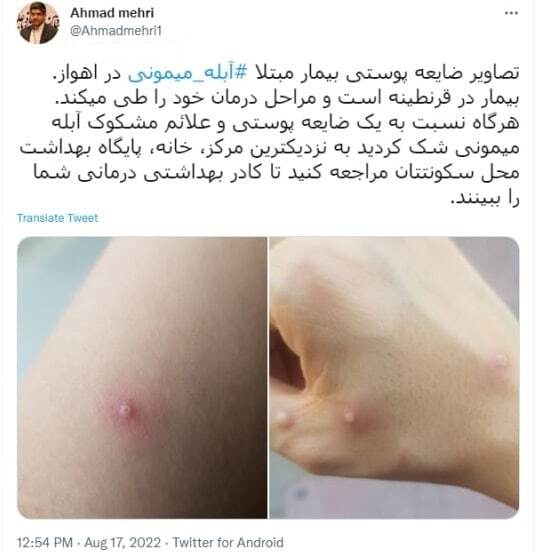 تصاویر ضایعه پوستی بیمار مبتلا آبله میمونی در ایران