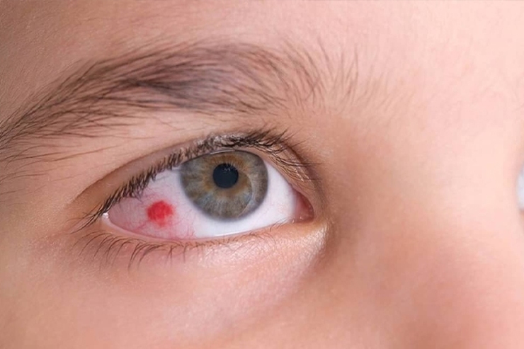 خونریزی چشم کودکان چه دلایلی دارد؟