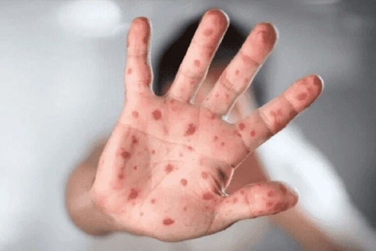 همزمان با گزارش موارد ابتلا به بیماری آبله میمونی در برخی کشورهای آسیایی، این قاره در حالت آماده باش قرار گرفت.