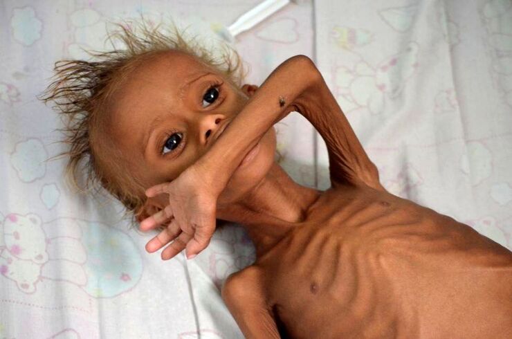 مرگ روزانه ۸۰ نوزاد در یمن به دلیل کمبود امکانات