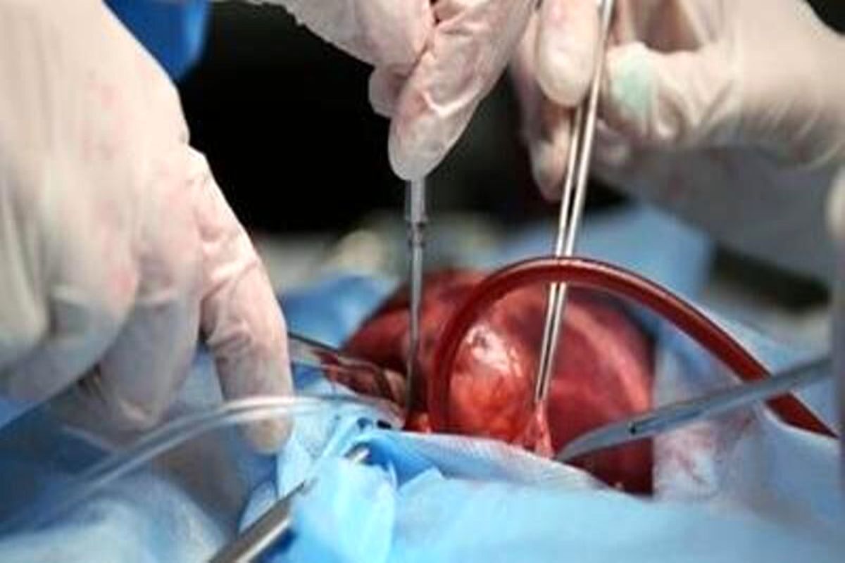 ویدئو| جراحی و عمل پیوند کلیه
