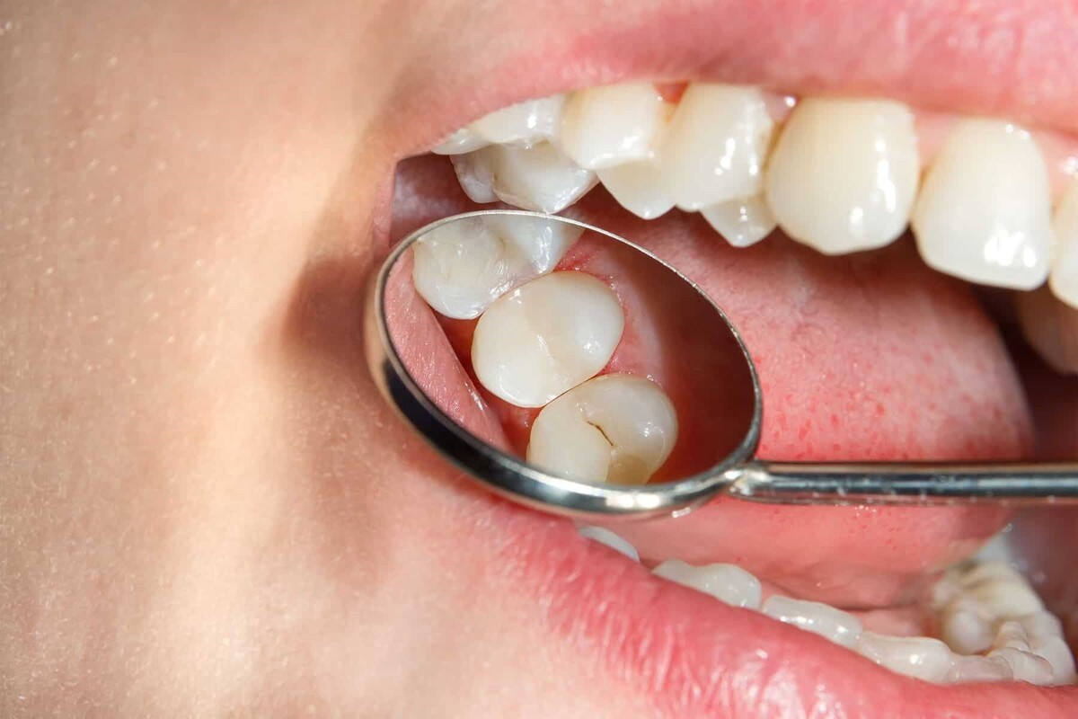 ویدئو| روش‌هایی برای پیشگیری از پوسیدگی دندان