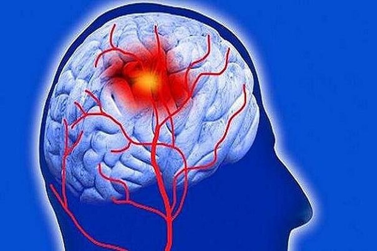 زمان طلایی درمان سکته مغزی سه ساعت ابتدایی است 