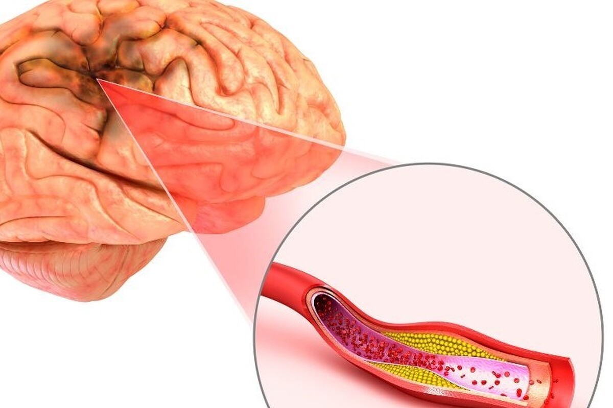 استرس، عامل افزایش احتمال خطر سکته مغزی در زنان