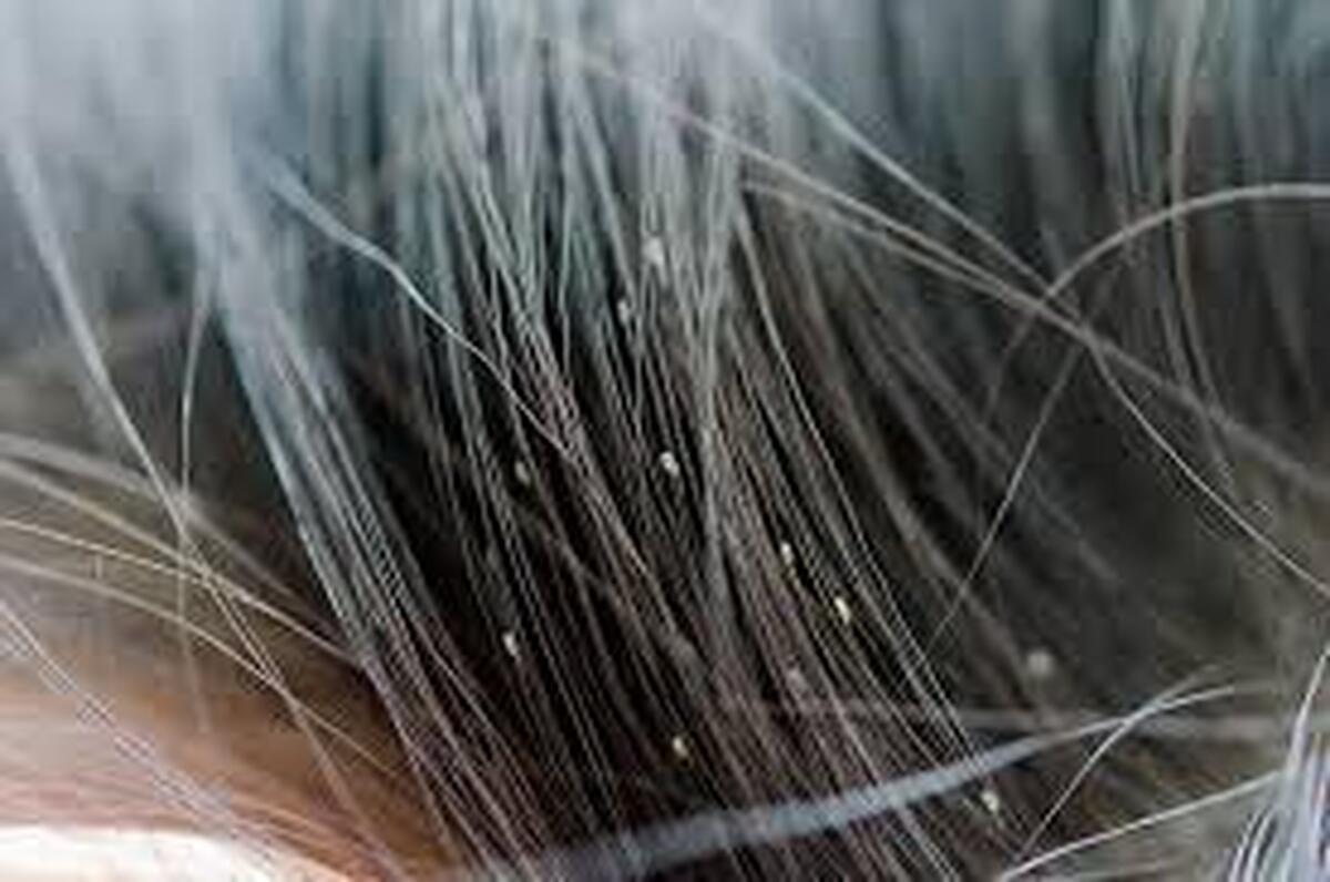 رعایت‌نکردن مراقبت‌های بهداشتی، می‌تواند سبب تخم گذاری شپش بر روی مو و پوست بدن شود