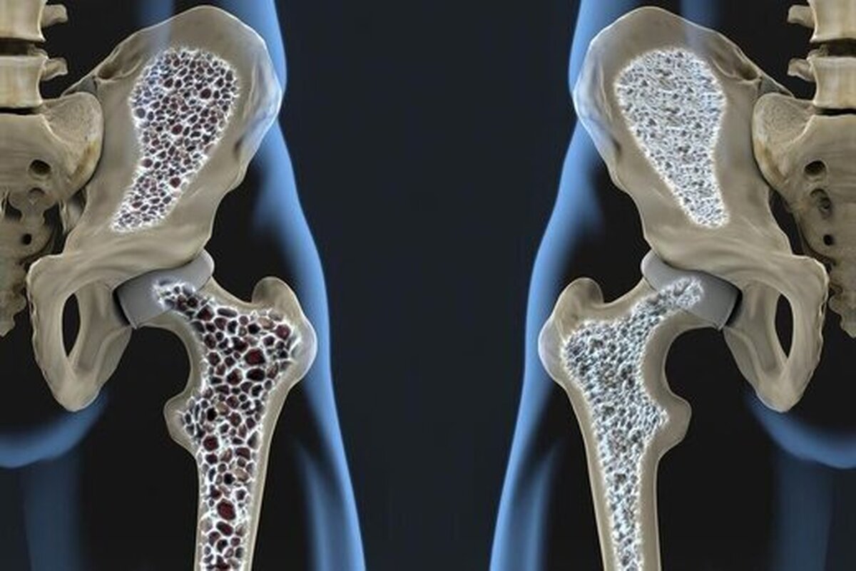 ۳۰ درصد زنان مبتلا به پوکی استخوان هستند 