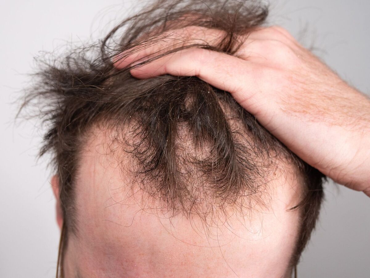 راه‌های درمان ریزش مو