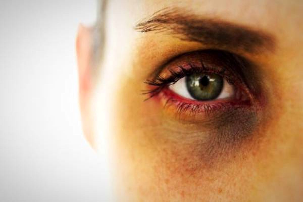 کمبود کدام ویتامین‌ها عوامل سیاهی دور چشم هستند؟