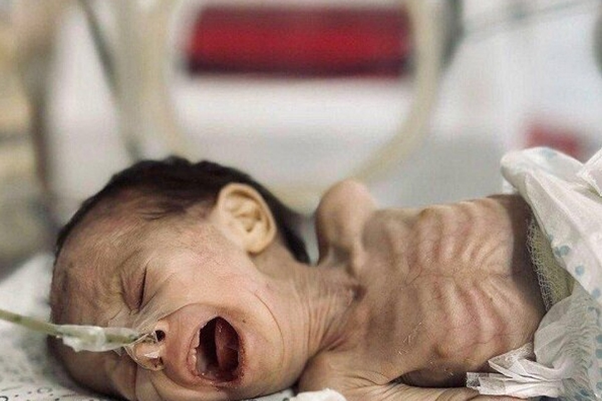 شهادت یک کودک فلسطینی دیگر در غزه بر اثر گرسنگی
