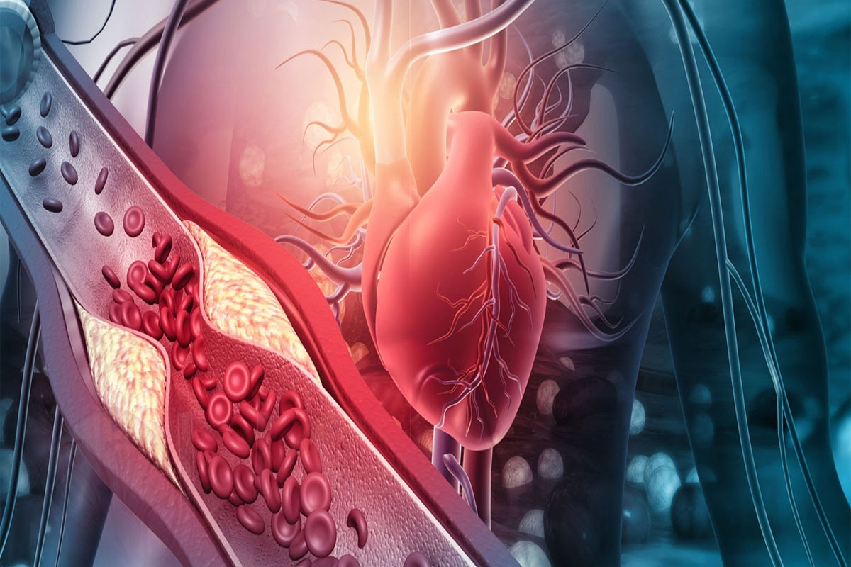 سبک زندگی نادرست زنگ خطری برای شروع بیماری‌های قلبی | جریان زندگی در شریان‌های باز