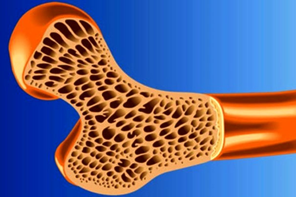 برنامه غربالگری پوکی استخوان در ۴ دانشگاه علوم پزشکی کشور در حال اجراست