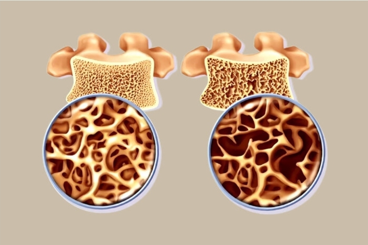 محققان دانشگاه ترینیتی دوبلین در پژوهش‌های جدید خود دریافتند، استخوان‌های تحلیل‌رفته ورزش و فعال‌سازی مسیر‌های خاص سلولی می‌تواند آنها را دوباره بازسازی کند و شاید این کشف جدید درمانی موثر برای پوکی استخوان باشد.