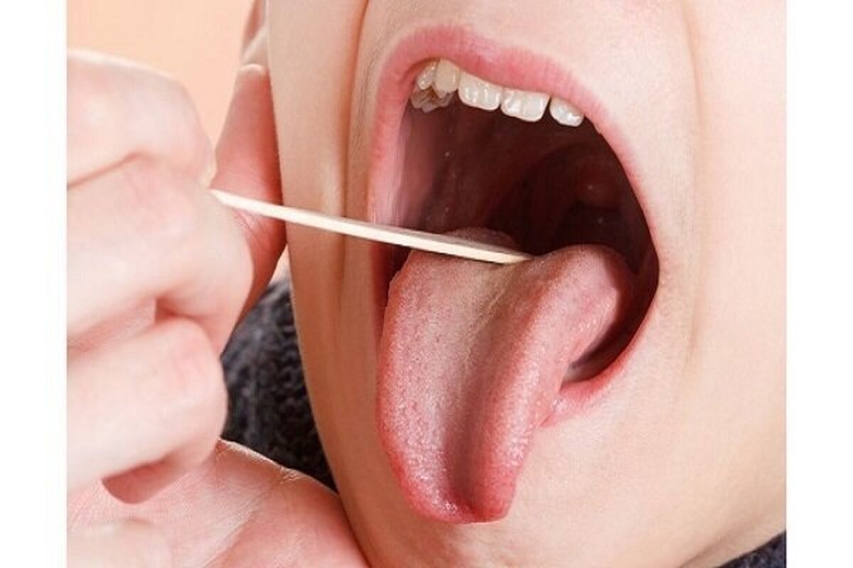 علت اصلی شکاف و تَرک روی زبان چیست؟