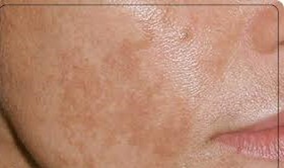 تازه‌ترین توصیه‌های پزشکی برای کنترل لک‌های پوستی