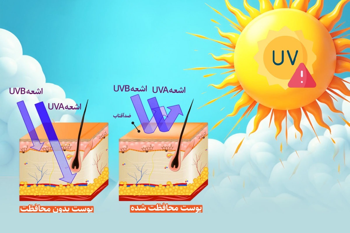 شاخص UV چیست و چرا باید روزانه آن را رصد کنیم؟ | سوختگی ارغوانی
