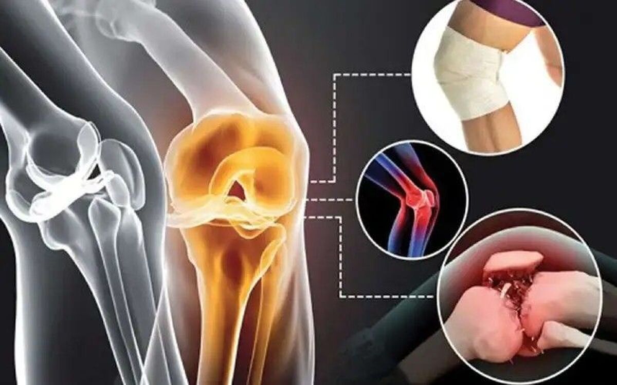 آرتروز زانو، یکی از شایع‌ترین بیماری‌های مفصلی در زنان