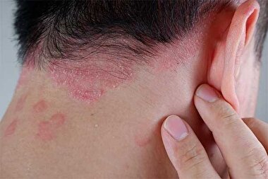 اینفوگرافی | چطور عارضه اگزمای صورت را شناسایی کنیم؟