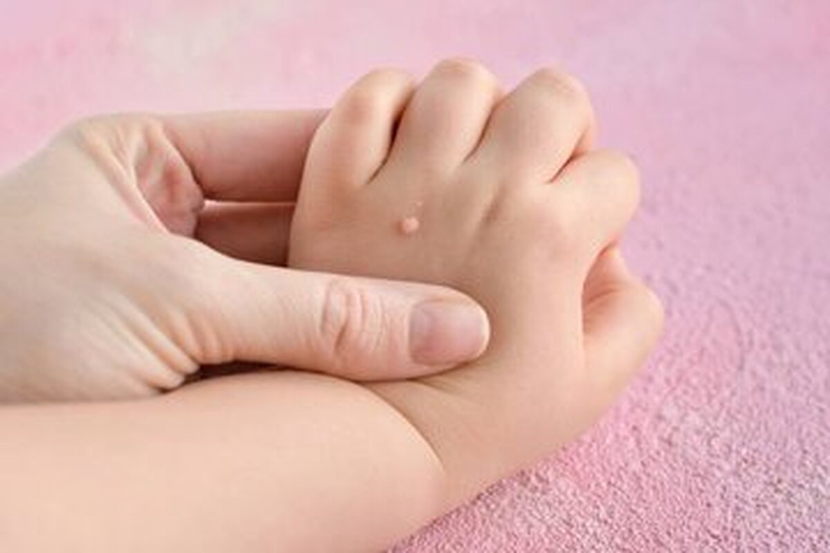 تفاوت خال گوشتی و زگیل چیست؟ | آیا کندن زگیل با ناخنگیر یا بستن نخ خطرناک است؟